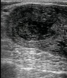 Endométrite purulente.